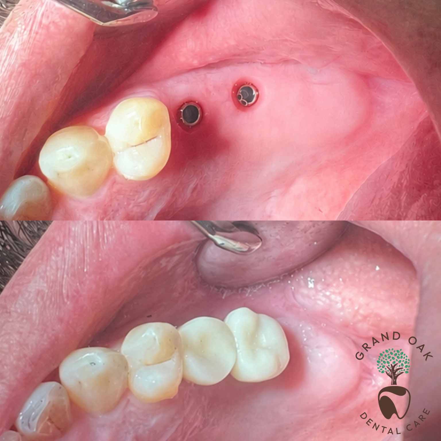 Single Implant Tooth Replacements